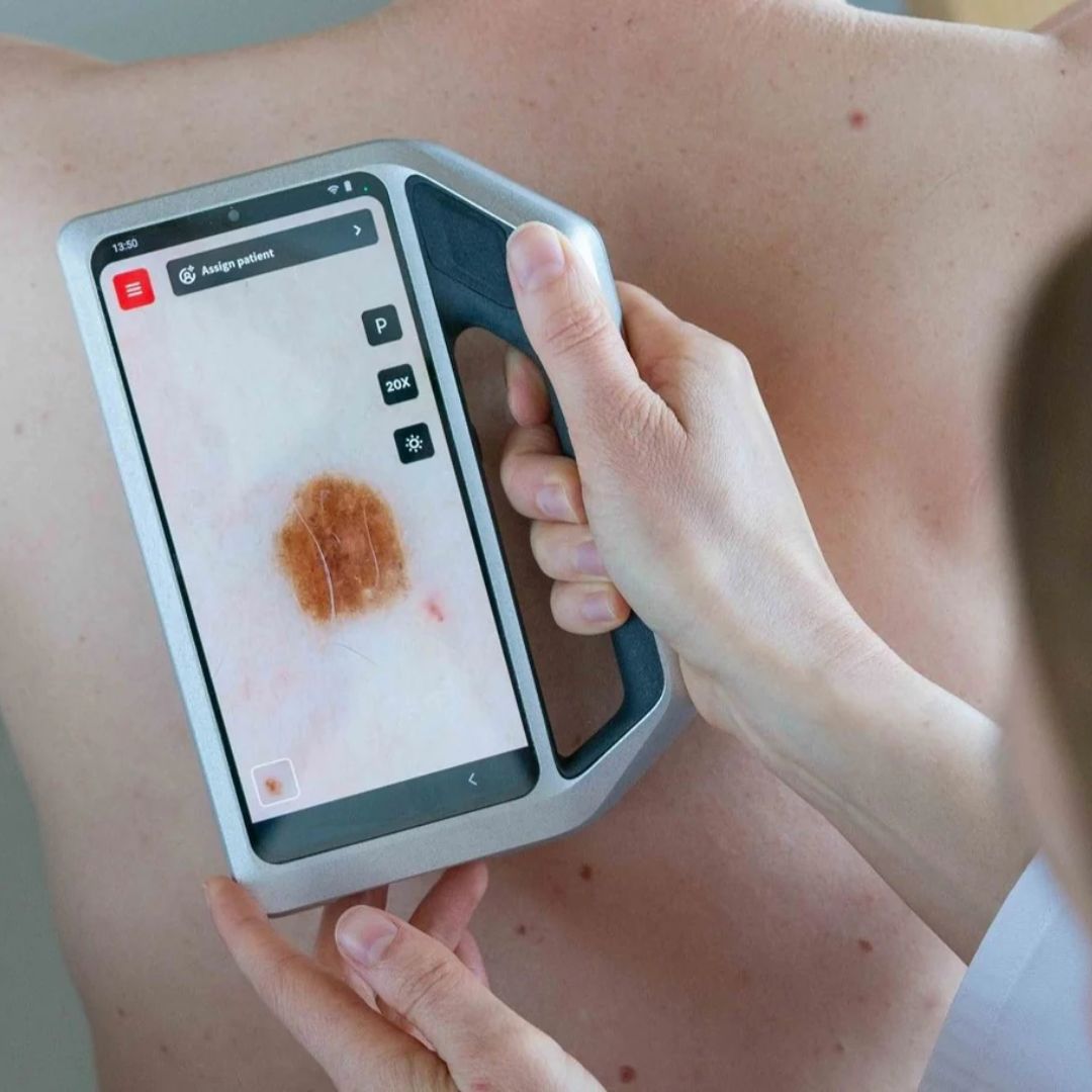 FotoFinder® skeen  intelligens digitális dermatoszkóp