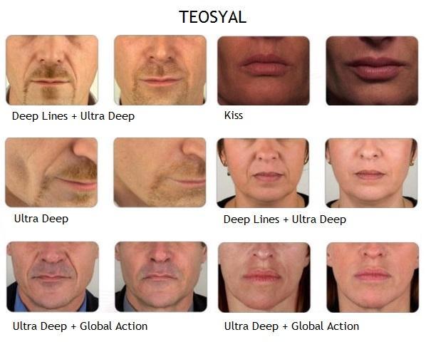 ránctöltés ajaktöltés szájtöltés hialuronsavval