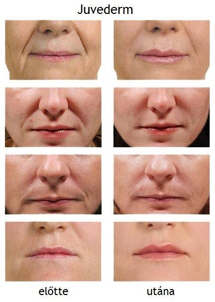 ráncfeltöltés ajakfeltöltés hialuronsavval